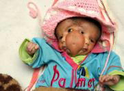 Nace en la India un beb&eacute; con dos caras